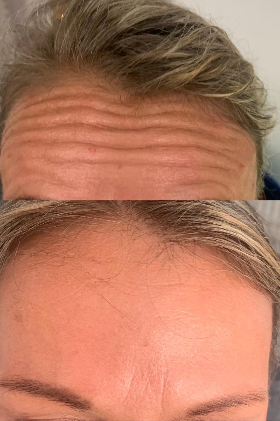 Placeholder single image for an anti wrinkle treatment comparison showing before and after positioning