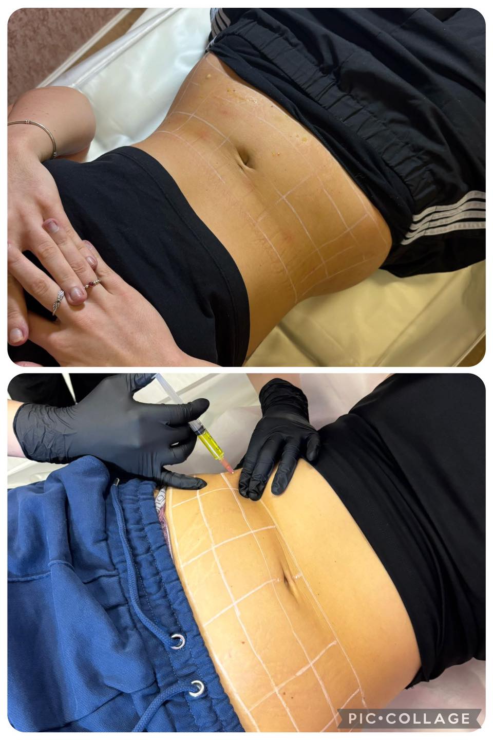 Placeholder single image for a fat dissolving treatment comparison showing before and after positioning