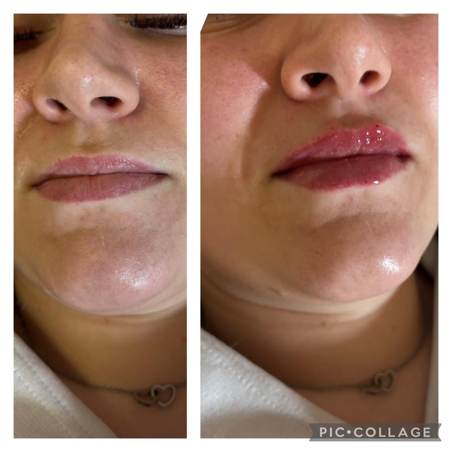 Placeholder single image for a lip filler treatment comparison with before on the left and after on the right