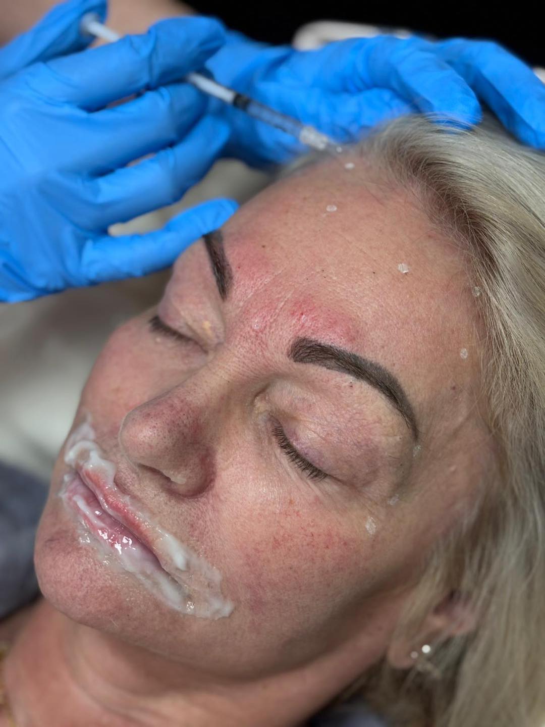 Placeholder image for the anti wrinkle injections treatment service