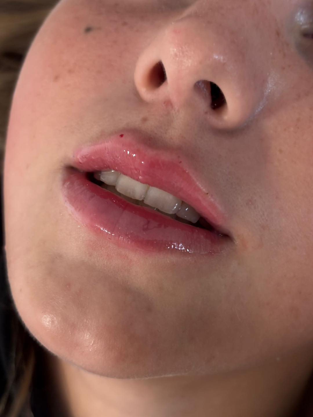 Placeholder image for the lip filler treatment service